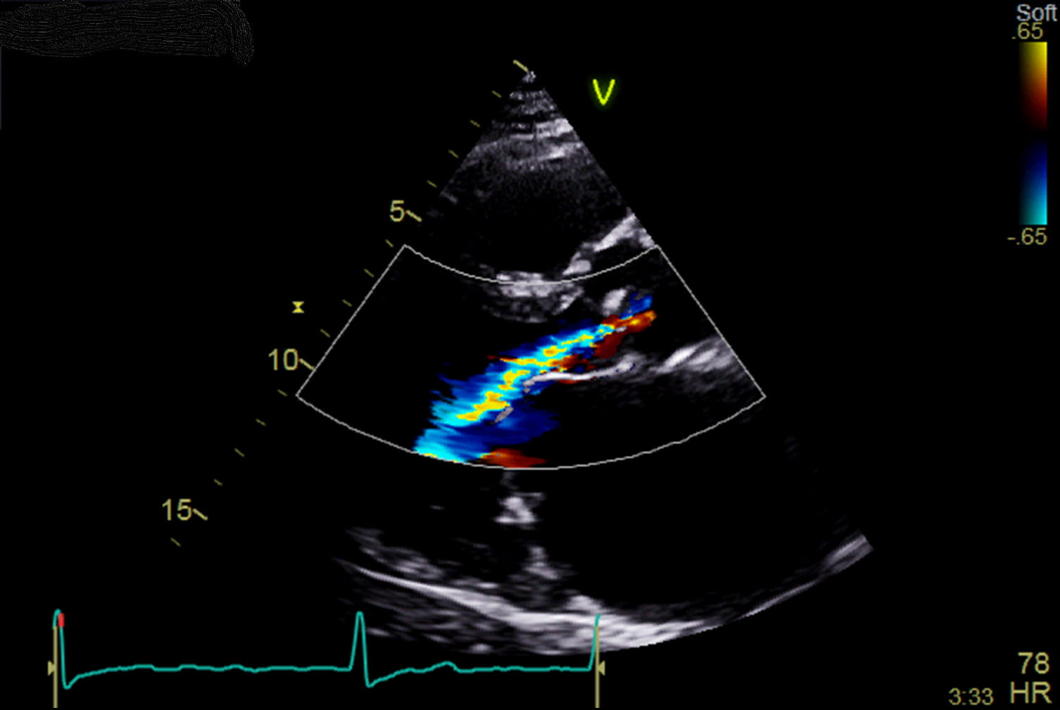 scan showing valve regurg