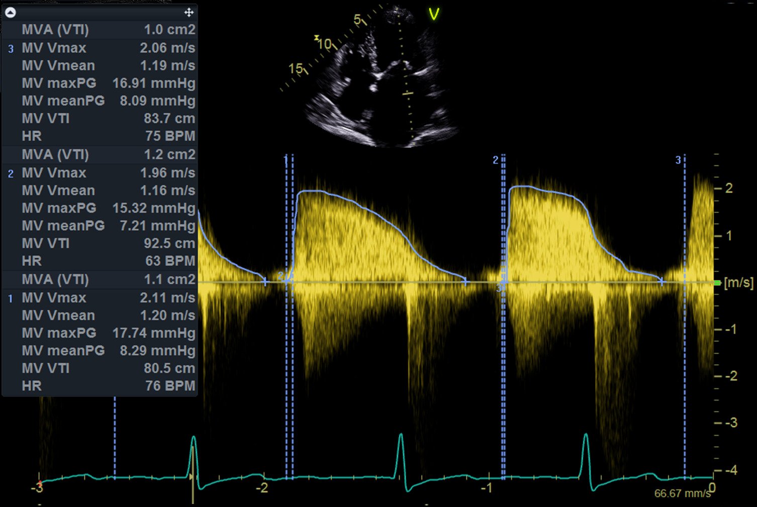 valve stenosis scan